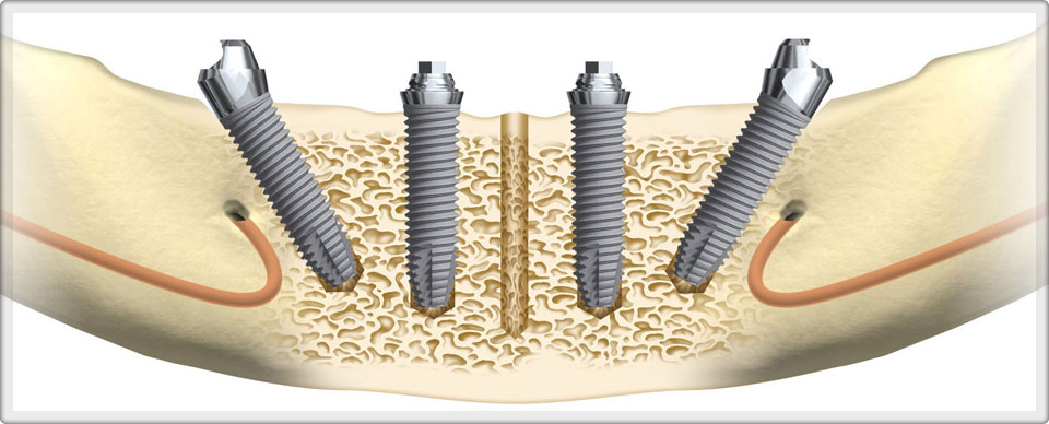 Full Mouth Rehabilitation